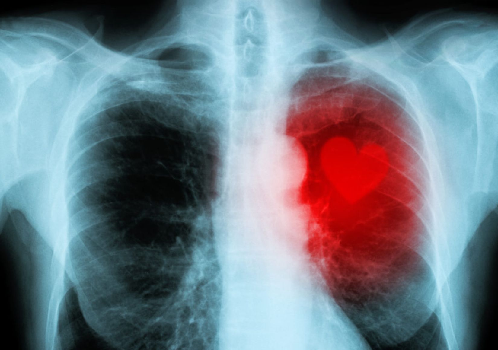 A human X-Ray of the upper torso with a red cartoon heart on the right hand side