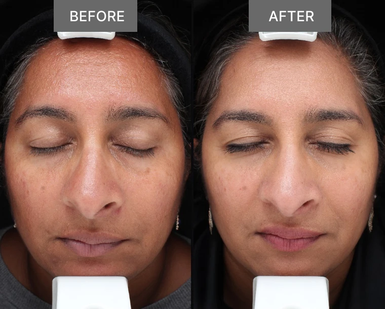 Subject 5 Before and After Ingenious Collagen