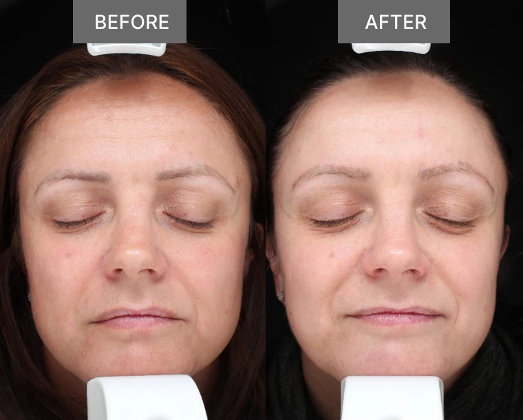 Subject 6 Before and After Ingenious Collagen