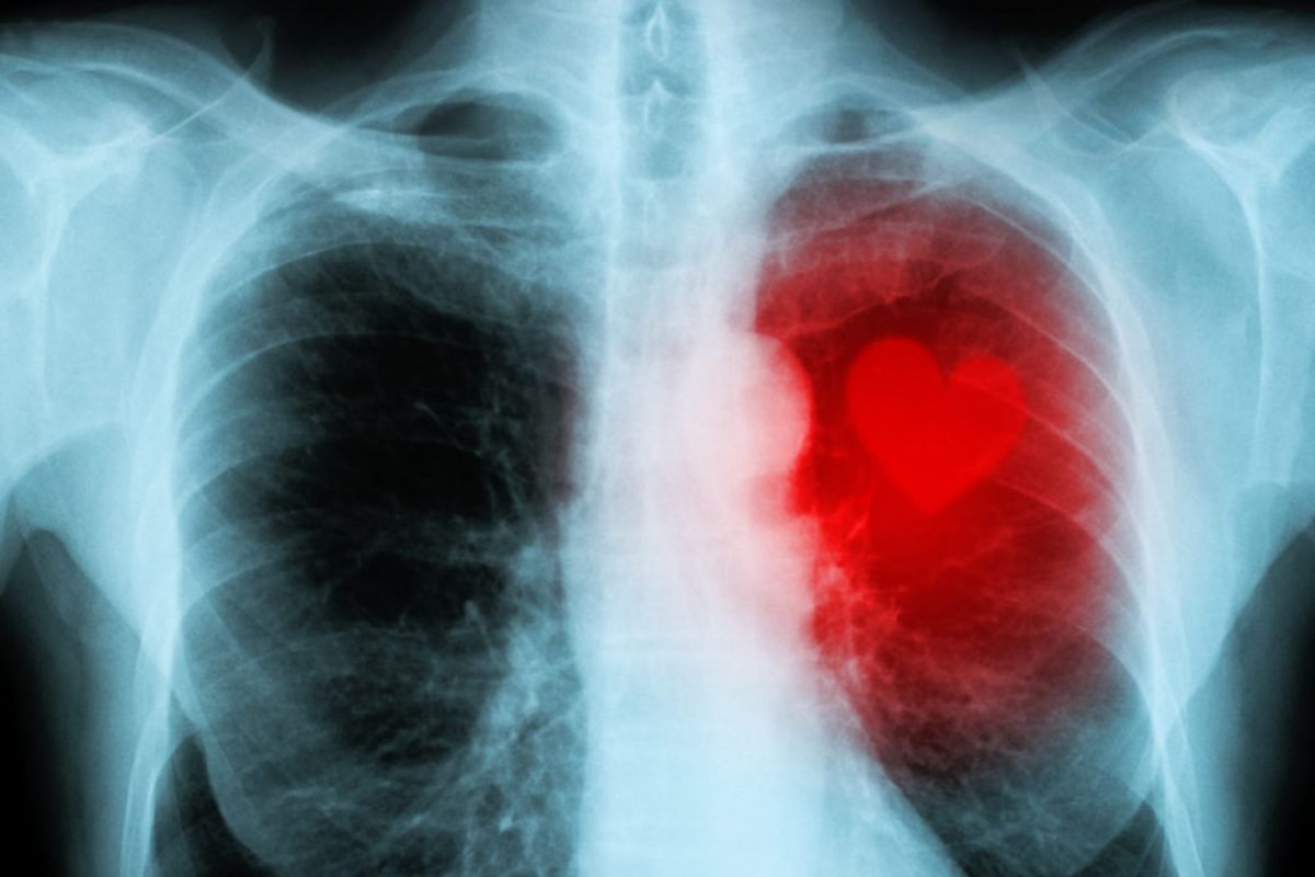 A human X-Ray of the upper torso with a red cartoon heart on the right hand side